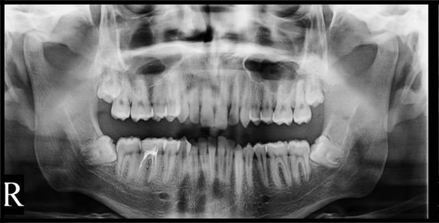 A radiograph from the held-out set