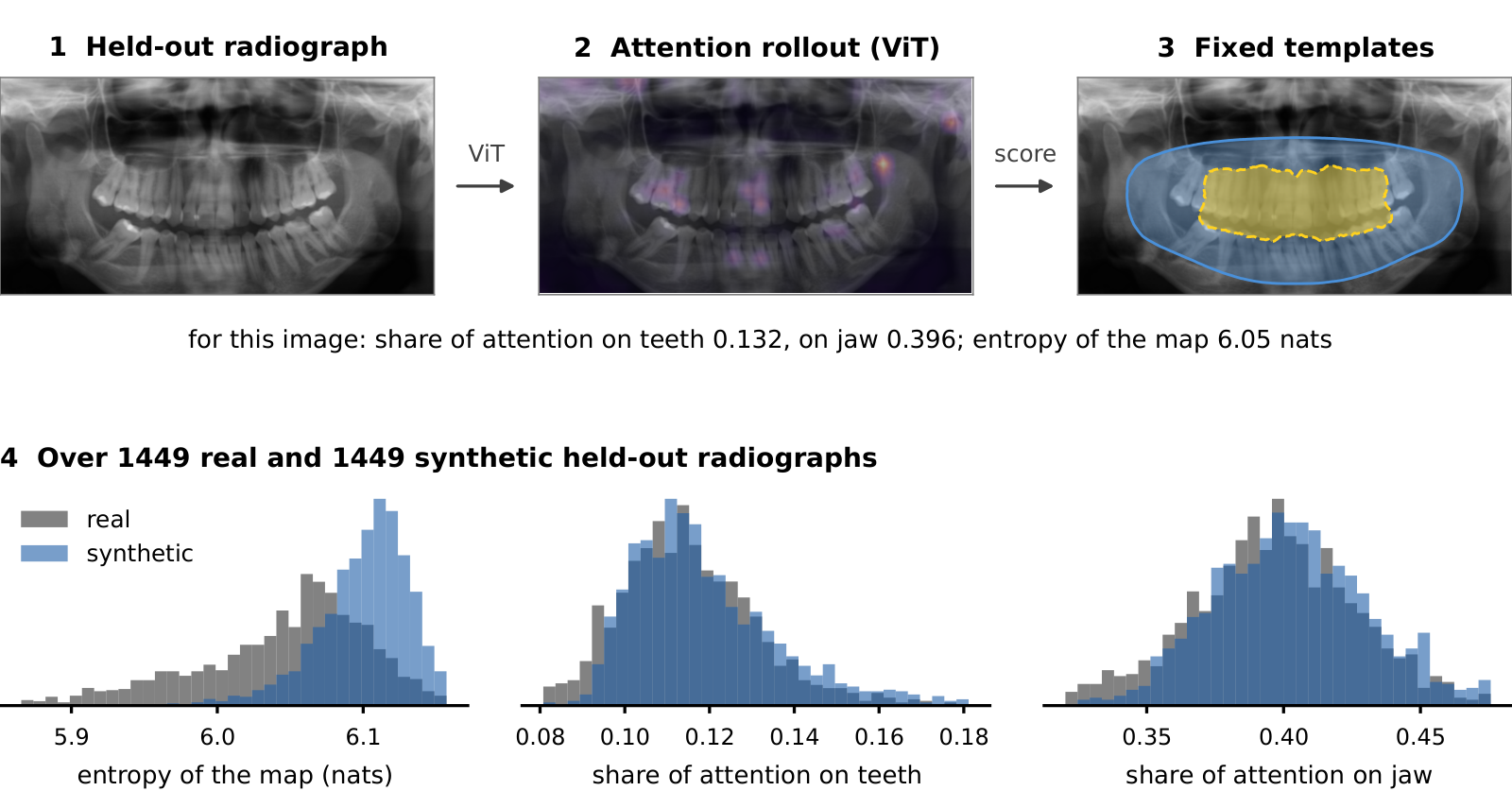 How the attention statistics are computed: a radiograph, its attention map, the anatomical templates, and the distributions over the held-out set