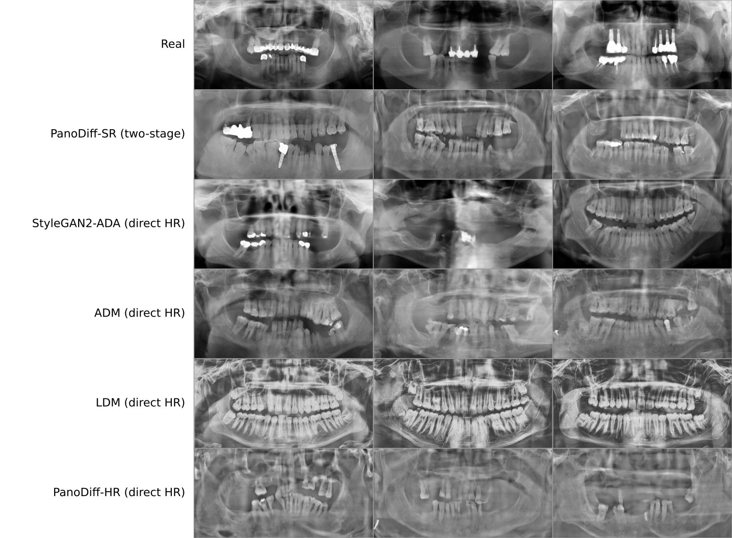 Random samples from each direct high-resolution baseline alongside real radiographs and the two-stage pipeline