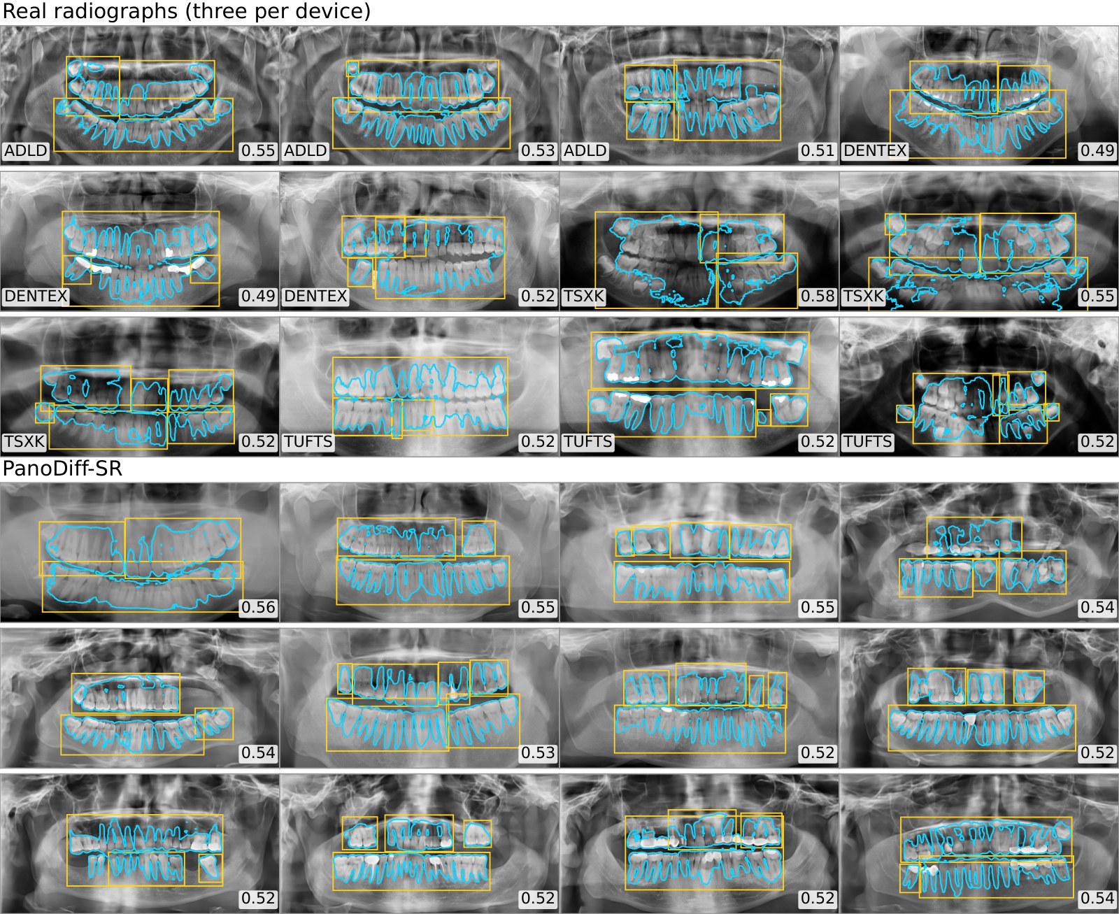 MedSAM masks on twelve real and twelve synthetic radiographs with tooth-region prompts