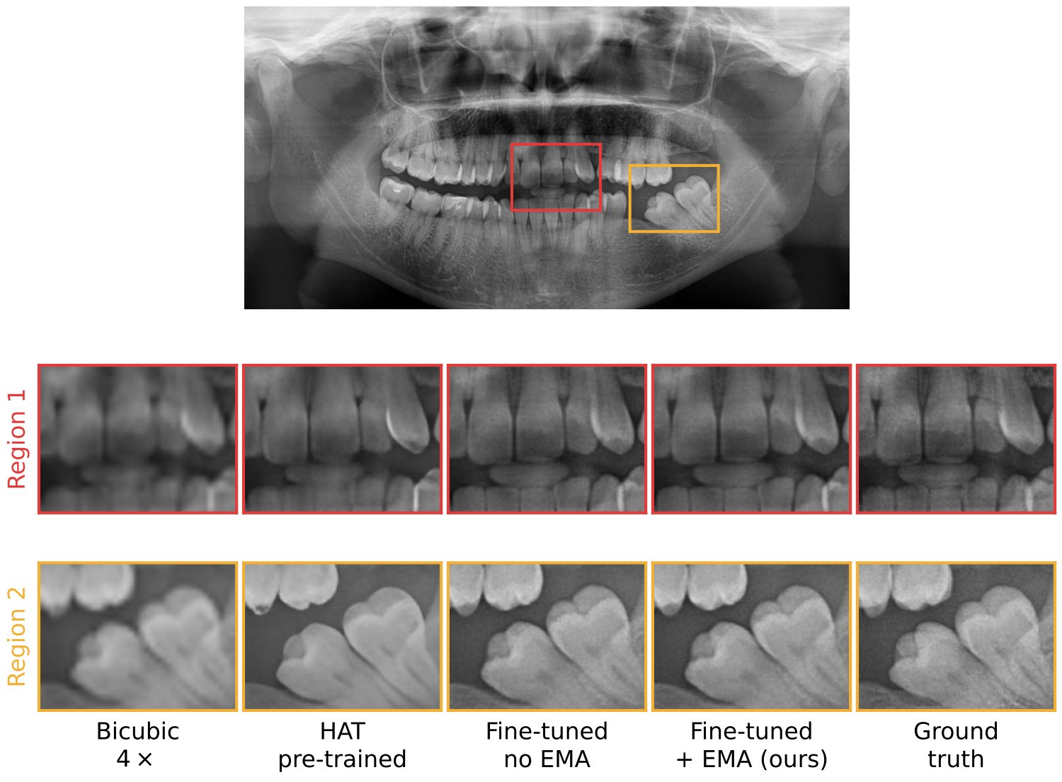Two magnified crops of one radiograph restored five ways: bicubic, stock HAT, fine-tuned without EMA, fine-tuned with EMA, and ground truth