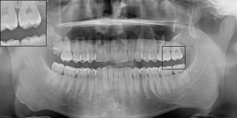 A synthetic radiograph produced by the selected generation and upscaling arm