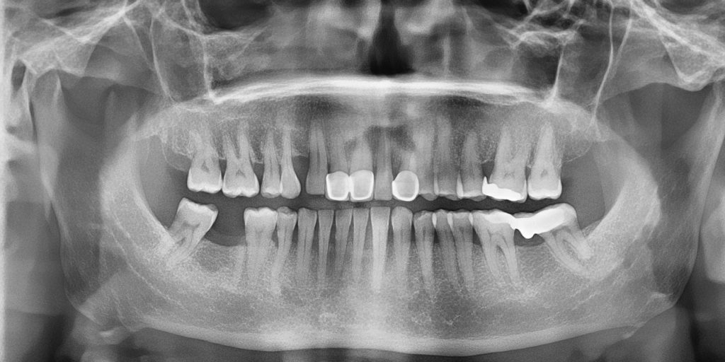 The same radiograph after HAT super-resolution
